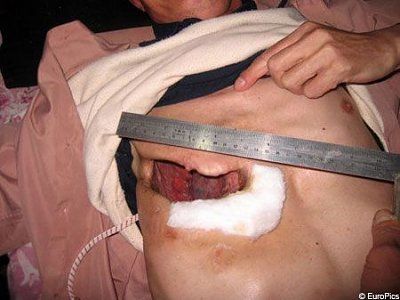 man-visible-heart-heartsurgeryep_450x337.jpg