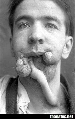 facial-reconstruction-performed-soldiers-injured-during-wwi-ped1.jpg