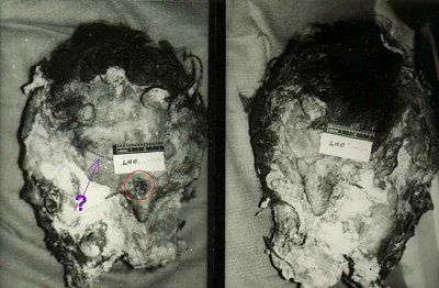 exhumed-head-lee-harvey-oswald-oswaldhead.jpg