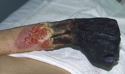 gangrene-hand-gangrene_hand.jpg