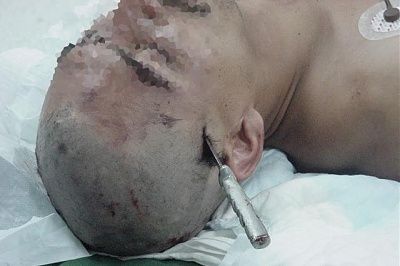 extreme-stab-wound-knife-head-neuro0008a.jpg