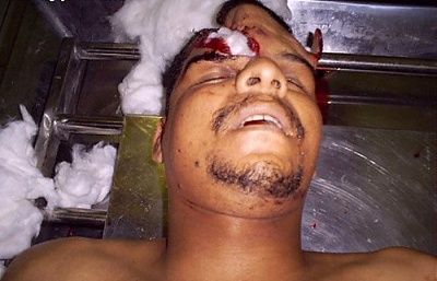 skull-fracture-motorcycle-accident-skull-fracture-motorcycle-accident-1.jpg