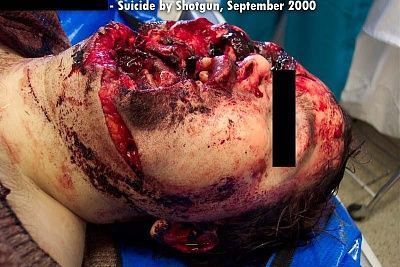 suicide-shotgun-blast-shotgunsuicide1.jpg