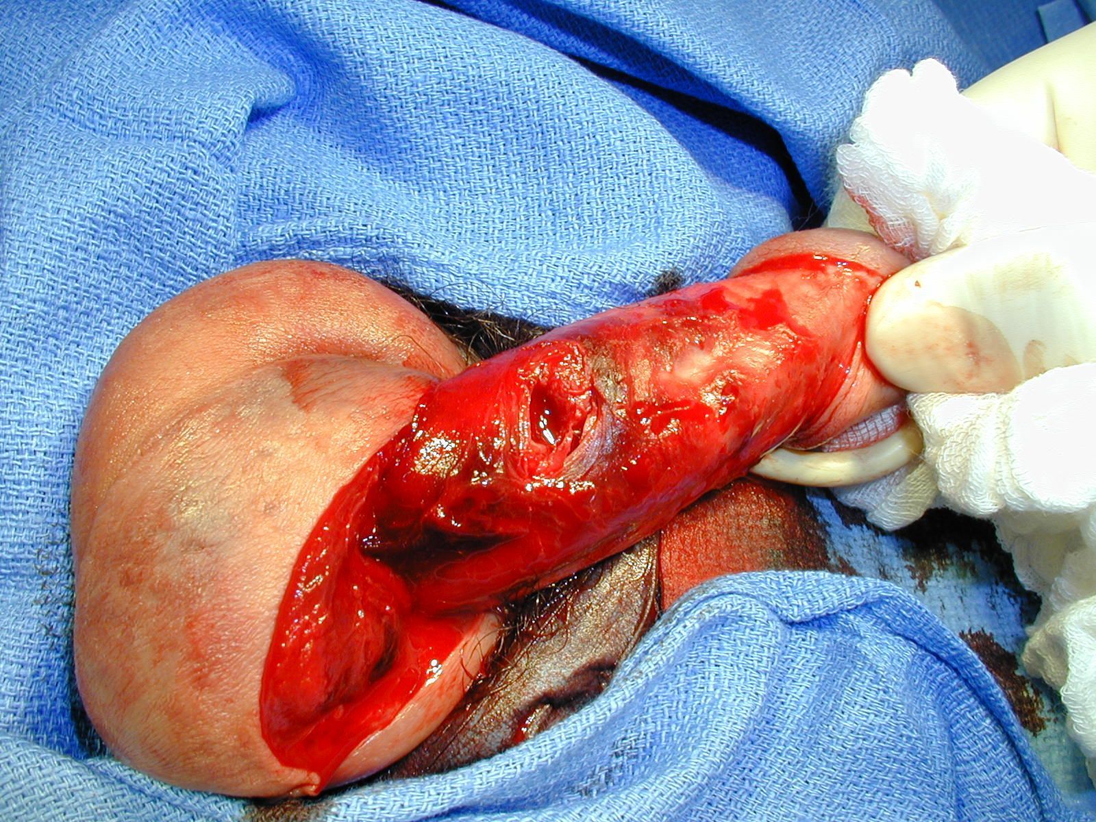 Penile+fracture