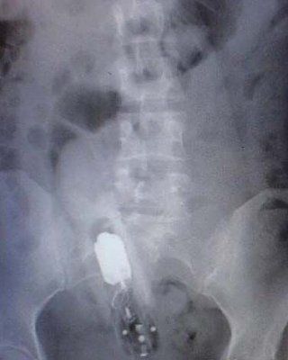 surgical-vibrator-removal-1.jpg