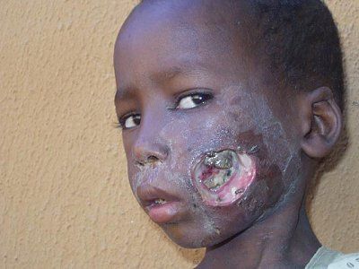 noma-disfigurement-freshnoma12.jpg