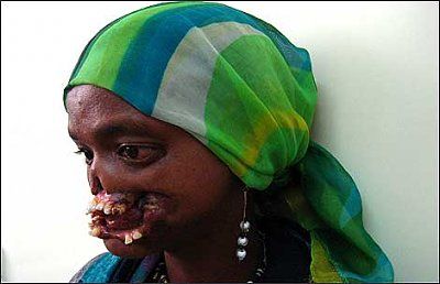 noma-disfigurement-woman_side470_470x303.jpg