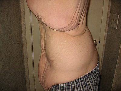 gastric-bypass-before-after-pictures-gastric-bypass-pictures-3.jpg