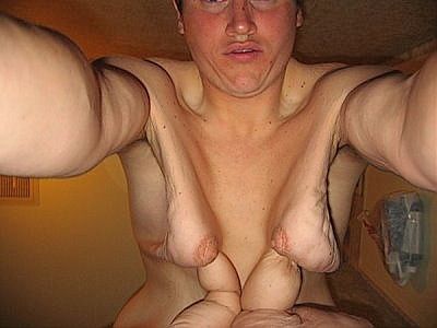 gastric-bypass-before-after-pictures-gastric-bypass-pictures-4.jpg