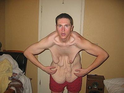 gastric-bypass-before-after-pictures-gastric-bypass-pictures-6.jpg