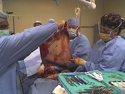 gastric-bypass-before-after-pictures-gastric-bypass-pictures-9.jpg