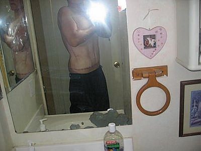 gastric-bypass-before-after-pictures-gastric-bypass-pictures-10.jpg