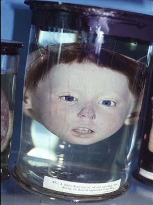medical-research-baby-colin-head.jpg