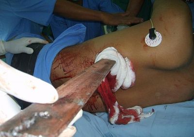man-empaled-metal-sign-pole-picture5.jpg