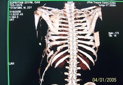 man-empaled-metal-sign-pole-picture7.jpg