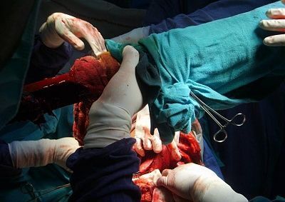 man-empaled-metal-sign-pole-picture9.jpg