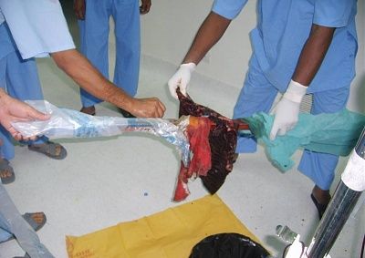 man-empaled-metal-sign-pole-picture10.jpg