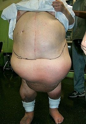 tummy-tuck-surgery-pictures-ttuck1.jpg