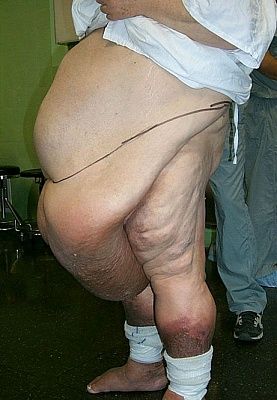 tummy-tuck-surgery-pictures-ttuck2.jpg
