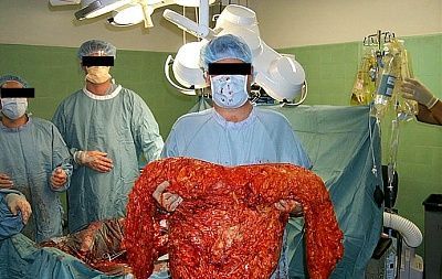 tummy-tuck-surgery-pictures-ttuck3.jpg