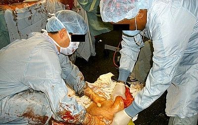tummy-tuck-surgery-pictures-ttuck4.jpg