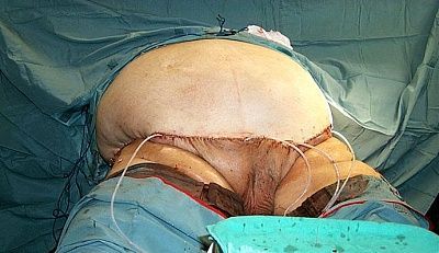 tummy-tuck-surgery-pictures-ttuck5.jpg