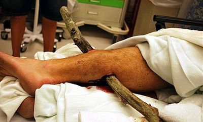leg-impalement-bike-ride-stickinleg2rsmm3.jpg