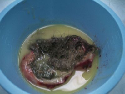 dermoid-cyst-carterfig2c.jpg