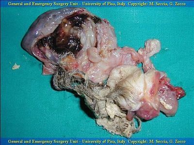 dermoid-cyst-diapositiva3_jpg.jpg