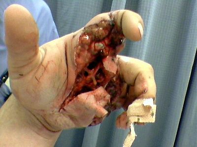 hand-ripped-apart-pre-post-surgery-pre.jpg