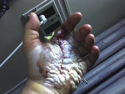 hand-ripped-apart-pre-post-surgery-post.jpg