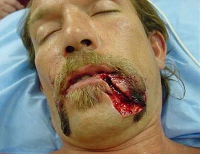 busted-lip-5fdadd64cf7a.jpg