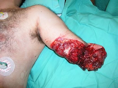 doctors-try-reattach-arm-reattacharm1.jpg