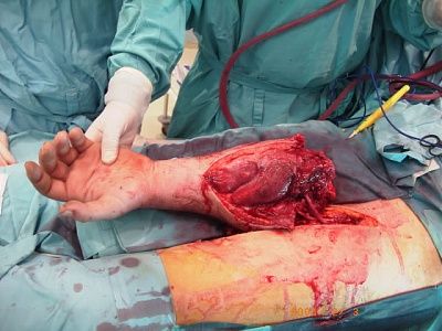 doctors-try-reattach-arm-reattacharm2.jpg
