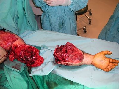 doctors-try-reattach-arm-reattacharm3.jpg