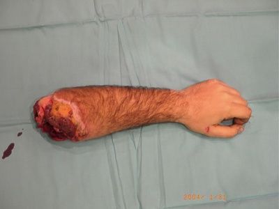doctors-try-reattach-arm-reattacharm4.jpg