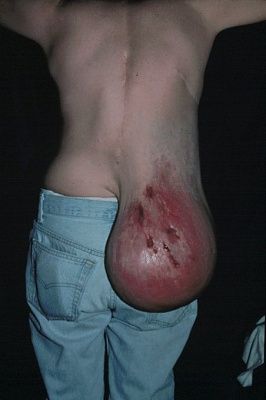 neurofibromatosis-type-1-picture-2pict.jpg