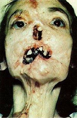 tertiary-syphilis-syphilis.jpg
