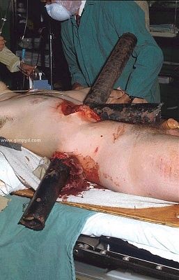 tree-limb-impalement-tree.jpg