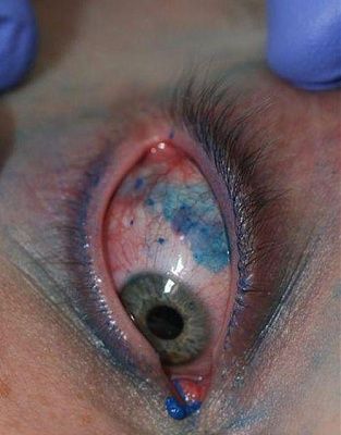 pictures-eye-tattoo-eye-tattooing1_1822.jpg