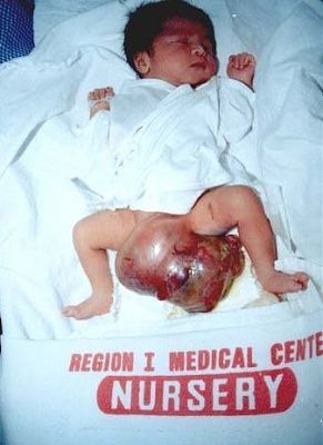sad-sacrococcygeal-teratoma.jpg