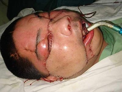face-transplant-2006-dn9010-1_650.jpg