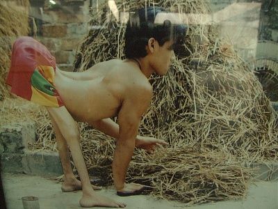 deformed-cambodian-boy-deformed-cambodian-boy.jpg
