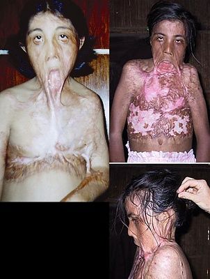 severe-burning-victim-severe-burning-victim.jpg