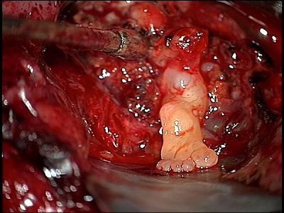 picture-colorado-springs-infants-foot-tumor-baby.jpg