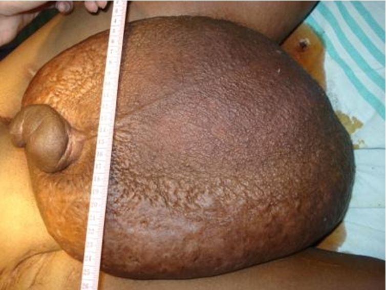 elephantiasis penis