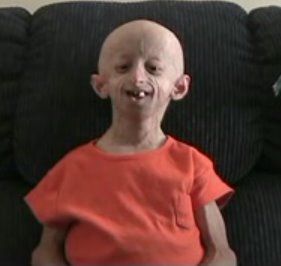 progeria