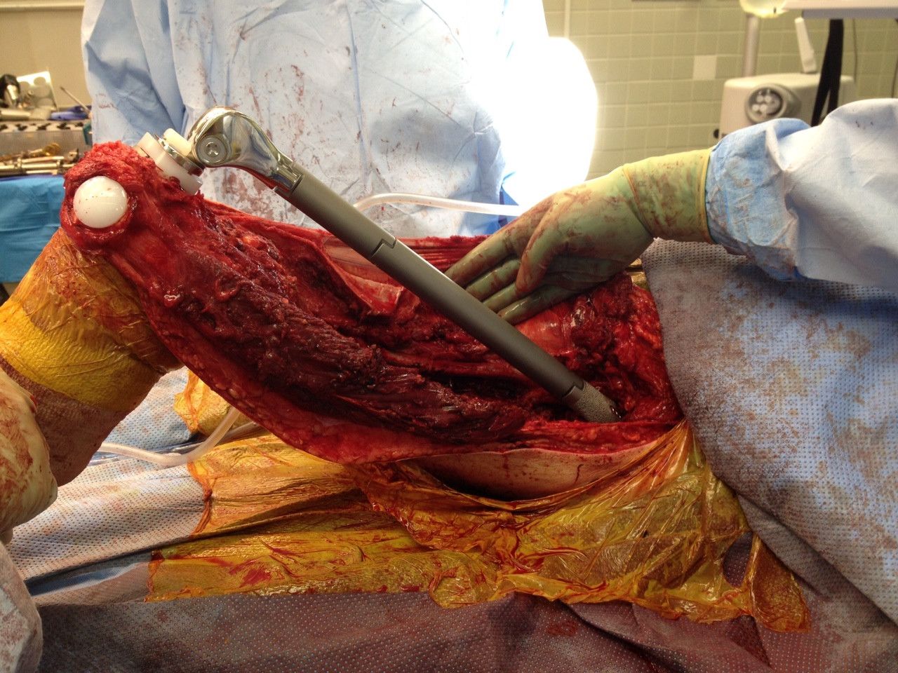 444368d1366661860-replacing-femur-titanium-rod-replacing-20the-20femur-20with-20a-20titanium-20rod.jpg