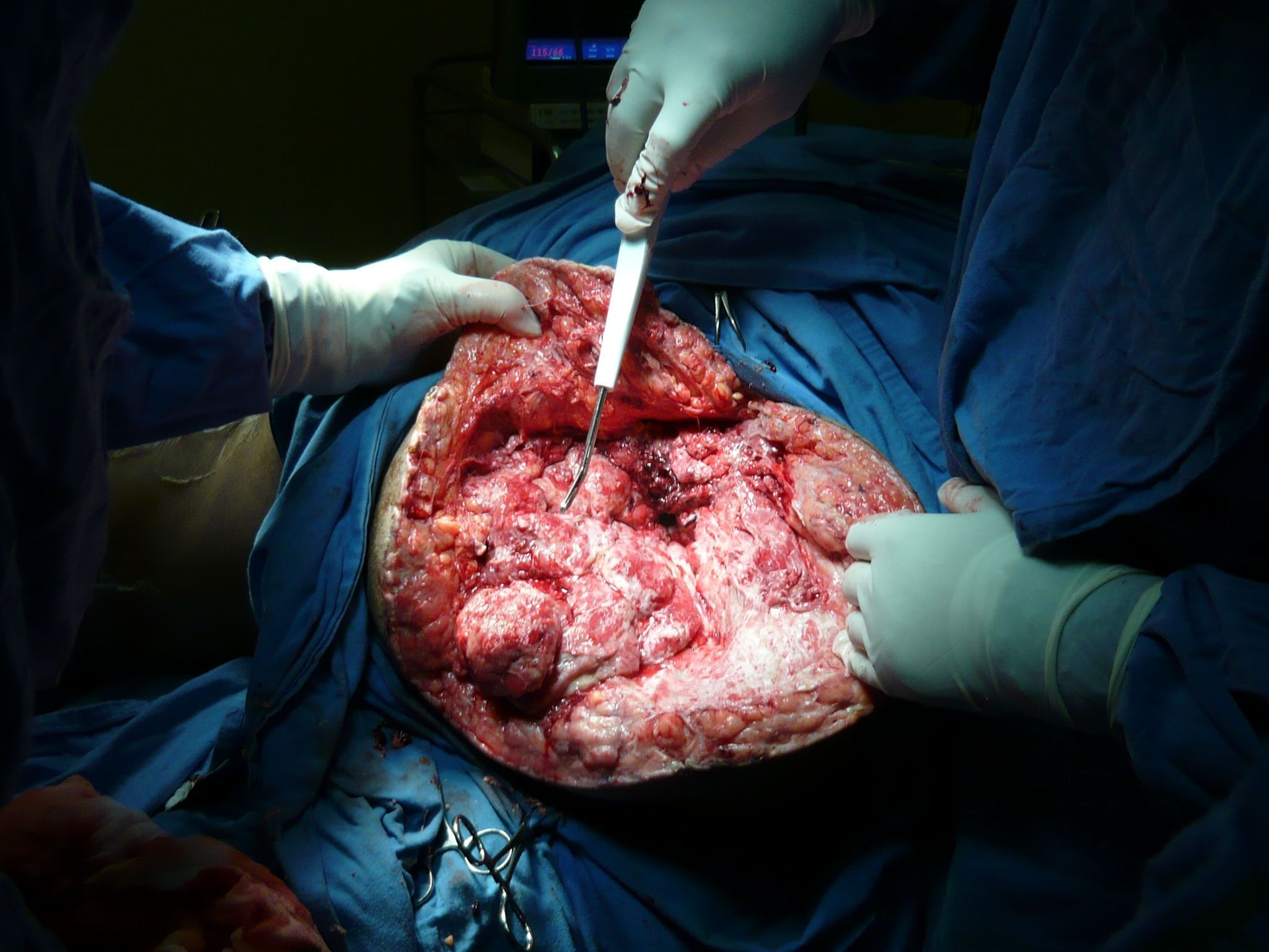 534366d1397837910-leg-amputation-surgery-my-sister-doctor-amputation_pictures_029.jpg