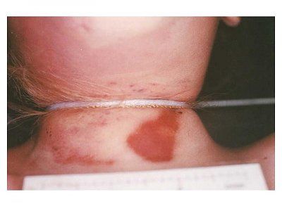 jonben-t-ramsey-autopsy-photos-neck1.jpg